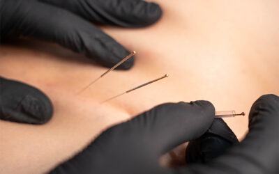 Dry Needling – съвременен метод във физиотерапията при болка, мускулен спазъм и спортни травми
