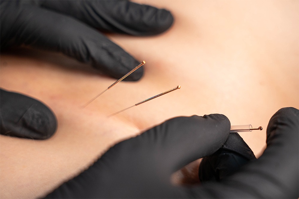 Dry Needling – съвременен метод във физиотерапията при болка, мускулен спазъм и спортни травми